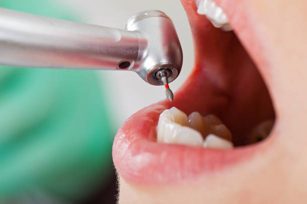 Best Dentist for Tooth Abscess  in Oroville, CA